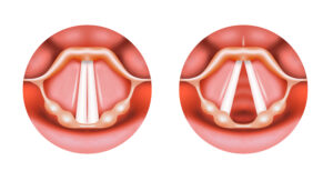 A imagem mostra duas vistas superiores das pregas vocais. À esquerda, as pregas vocais estão abertas, formando um triângulo. À direita, as pregas vocais estão fechadas, alinhadas no centro, como ocorre durante a produção de som. Ambas são brancas e contrastam com o tecido vermelho ao redor.