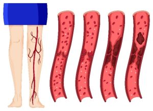 Ilustração detalhada mostrando diferentes estágios de má circulação na perna, desde veias saudáveis até veias obstruídas e inflamadas, representando complicações como uma ferida que não cicatriza.