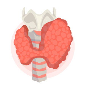 Ilustração da tireoide aumentada